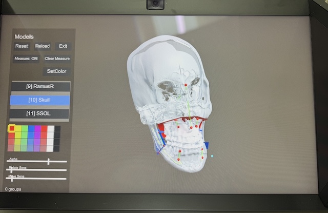 頭蓋骨3Dモデルにランドマーク点を打ち、計測表示している実画面