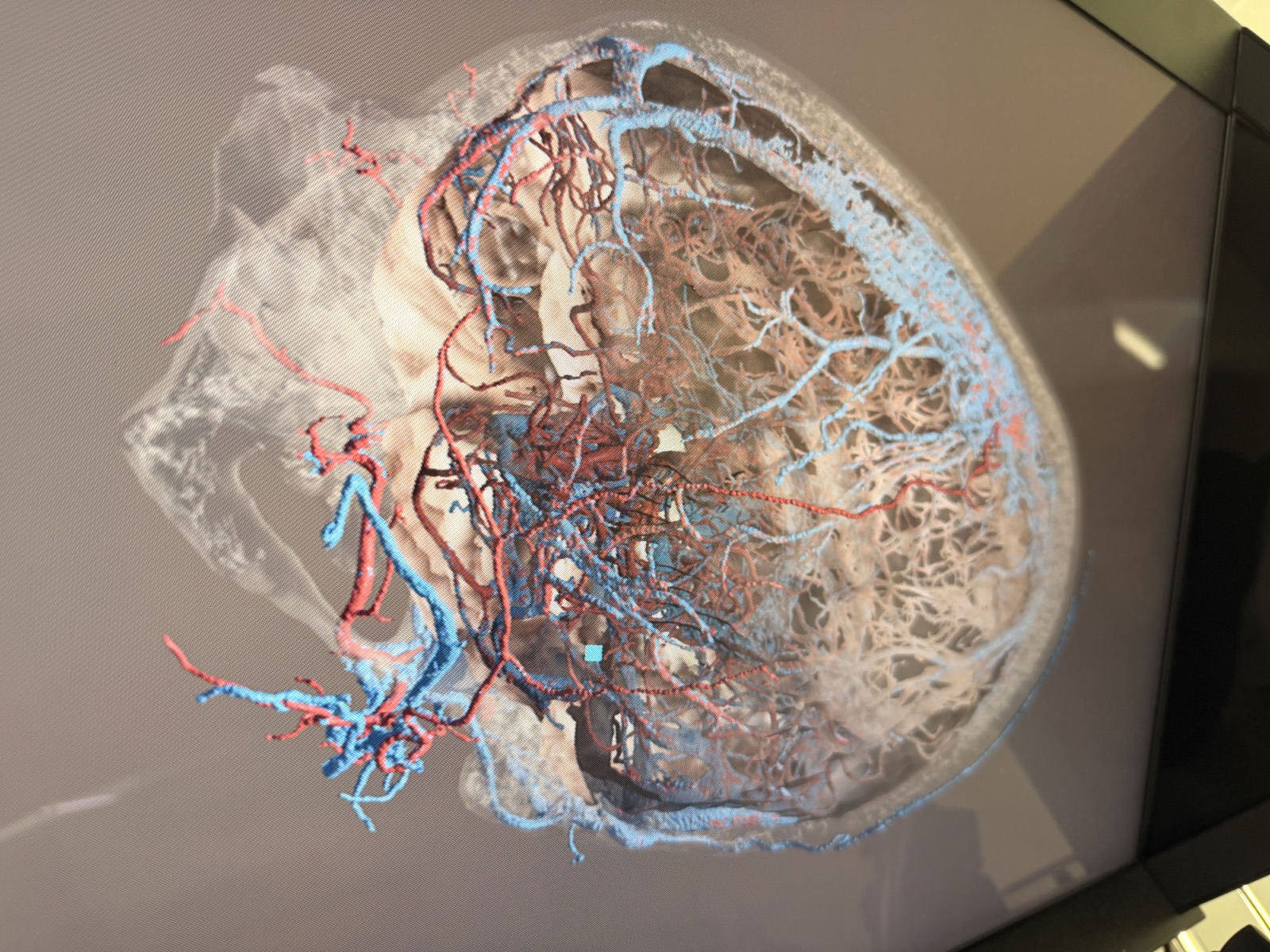 頭頸部の動脈・静脈を骨格とともに3D表示した実画面